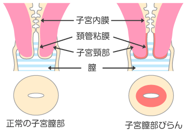 子宮膣部びらん